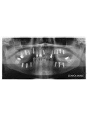 Dental Implants - SMILE Dental Clinic