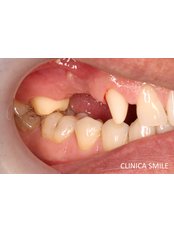 Porcelain Bridge - SMILE Dental Clinic