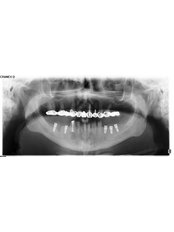 Dental Implants - Uzina de Zambete