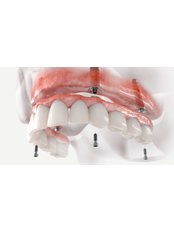 Porcelain Fixed Bridge on 4 Dental Implants - HappyDental