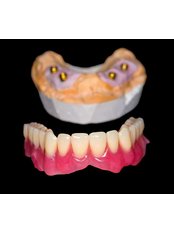 Dental Implant Retained Dentures - HappyDental