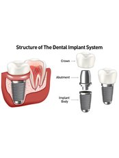 Dental Implant + Post + Zirconia Crown - HappyDental