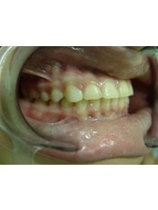 Restorative Dentist Consultation - Dr. Ivan Panaiotov Invisalign Specialist