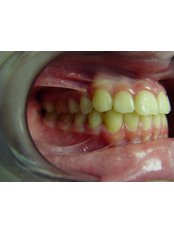 Orthodontist Consultation - Dr. Ivan Panaiotov Invisalign Specialist