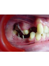 Dental Implants - Dr. Ivan Panaiotov Invisalign Specialist