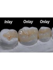 Inlay or Onlay - Beo Smile Design