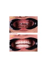 All-on-4 Dental Implants - Beo Smile Design