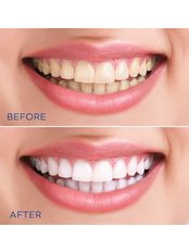 Teeth Whitening - Beo Smile Design