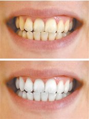 Teeth Whitening - Beo Smile Design