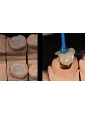Porcelain Filling - Center for Dental Esthetic and Implantology