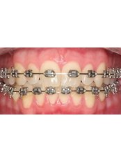 Fixed Braces - Center for Dental Esthetic and Implantology