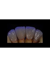 Porcelain Crown - Center for Dental Esthetic and Implantology