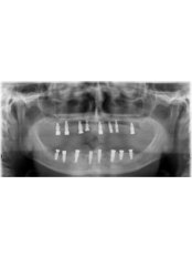 Dental Implants - Cvejanovic