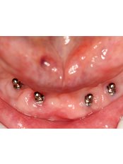 Mini Implants - Dental Clinic ORTO