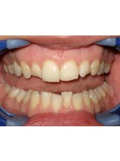 Dental Bonding - Dental Clinic ORTO