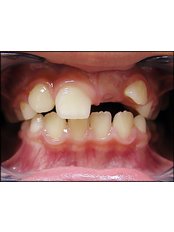Metal Braces - Dental Clinic ORTO