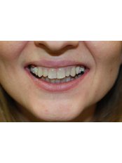 Porcelain Bridge - Dental Oral Centar
