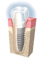 Dental Implants - MyDentist