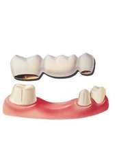 Dental Bridges - MyDentist
