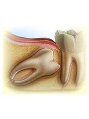 Wisdom Tooth Extraction - MyDentist