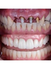 Dental Implants - Novadent Dental Centre