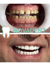 Veneers - Novadent Dental Centre