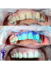 Dental Composite - Stomatološka Ordinacija Caninus