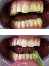 Teeth whitening in the Clinic (per jaw) - Stomatoloska Ordinacija Colic