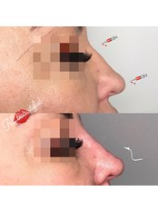 Non-Surgical Nose Job - Fill Beautiful Clinic