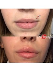 Lip Augmentation - Fill Beautiful Clinic