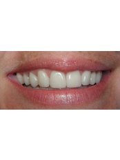 Veneers - Dental Clinic 