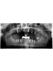 Dental Implants - Dr Lolin