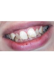 Zirconia Crown - Markov Dental Clinic