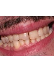 Teeth Whitening - Markov Dental Clinic