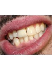 Teeth Whitening - Markov Dental Clinic