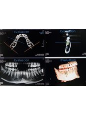 Dental Implants - Casa Dental (Holland)