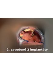 Restoration of Implants - Dent plus