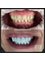 All Smiles Dentist, Century City - Smile Makeover: 6 upper and 5 lower Emax Crowns to make smile bolder and white 