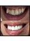 All Smiles Dentist - Century City - Smile Makeover:  6 upper and 6 lower Zirconium Crowns to straighten teeth and make them more attractive 