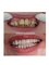 All Smiles Dentist, Century City - Smile Makeover: Full mouth of Porcelain fused Metal Crowns to straighten teeth and make smile brighter 