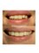 All Smiles Dentist, Century City - Smile Makeover: 4 Procelain fused Metal Crowns on upper front teeth 
