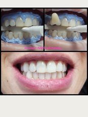 Happy Smiles Oral Hygiene & Teeth Whitening Studio - BEFORE & AFTER TEETH WHITENING IN OFFICE