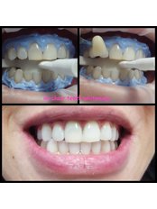 Happy Smiles Oral Hygiene & Teeth Whitening Studio - BEFORE & AFTER TEETH WHITENING IN OFFICE 