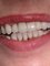 Hillcrest Dentist - smile Makeover 
