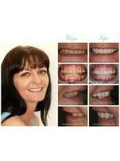 Cosmetic Dentist Consultation - Silver Oaks Dental Clinic