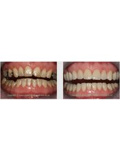 CEREC Dental Restorations - Silver Oaks Dental Clinic