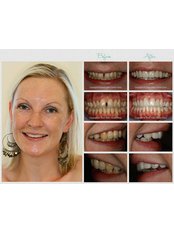 Lumineers™ - Silver Oaks Dental Clinic