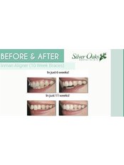 Removable Braces - Silver Oaks Dental Clinic