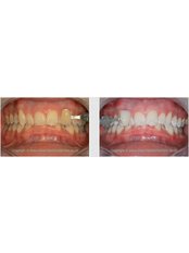 Teeth Whitening - Silver Oaks Dental Clinic