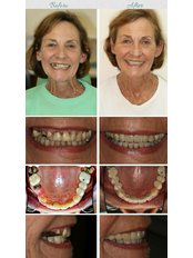 Dental Bridges - Silver Oaks Dental Clinic